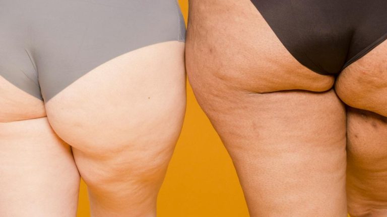Perdre la cellulite naturellement