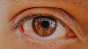 Glaucome