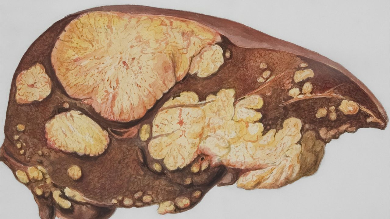 Mourir d’une cirrhose du foie