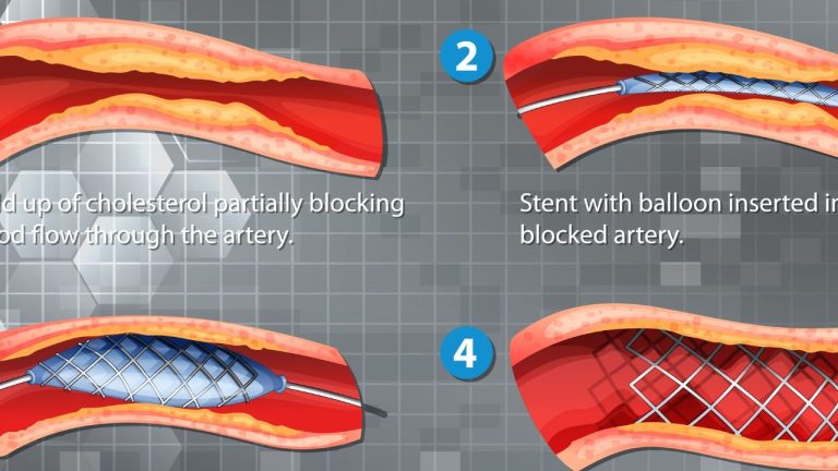 Stent coronarien